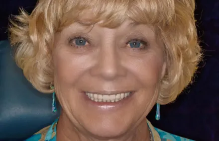 Anne after her dental treatment
