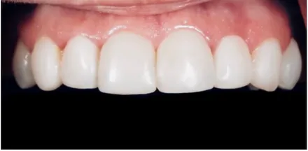 After: worn, yellowed front teeth restored to a bright, even smile