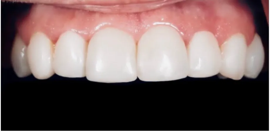 After: worn, yellowed front teeth restored to a bright, even smile