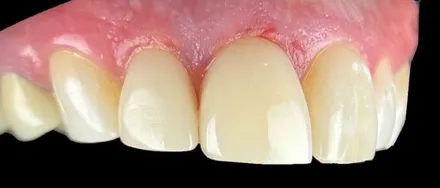 After: chipped and discolored front teeth restored with composite veneers