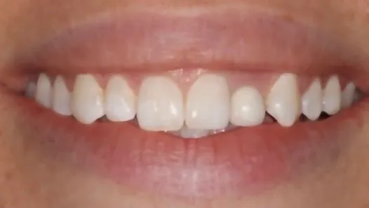Before: gapped, uneven smile made even and bright