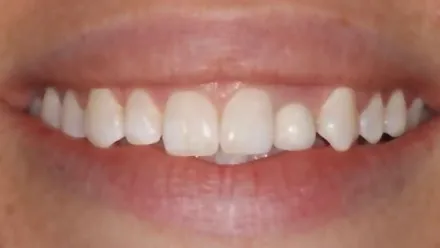 Before: gapped, uneven smile made even and bright