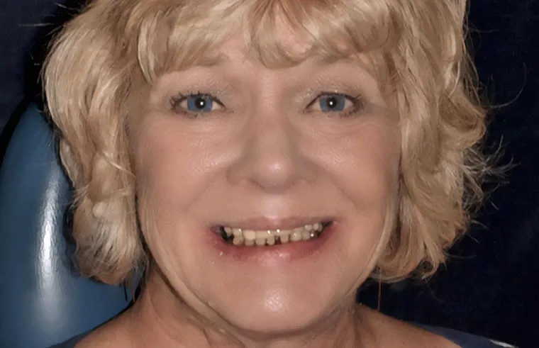 Anne before her dental treatment