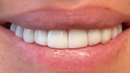 After: gapped, uneven smile made even and bright
