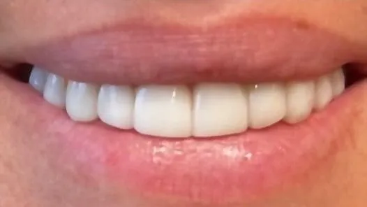 After: gapped, uneven smile made even and bright