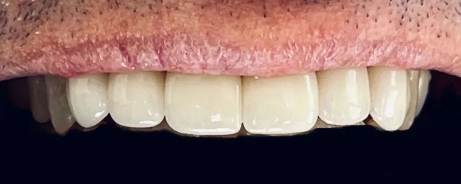 After: smile with veneers on the upper teeth