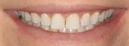 Before: upper front teeth with composite veneers