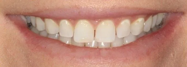 Before: upper front teeth with composite veneers
