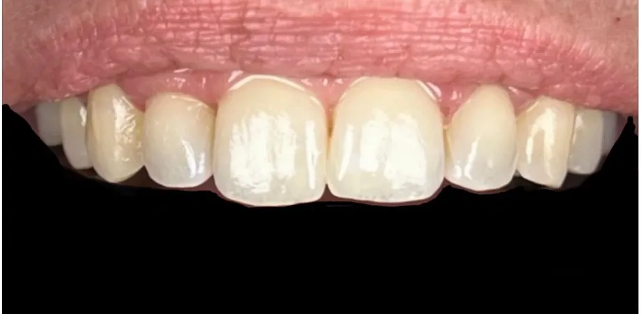 Before: worn, yellowed front teeth restored to a bright, even smile