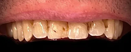 Before: smile with veneers on the upper teeth