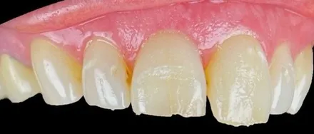 Before: chipped and discolored front teeth restored with composite veneers