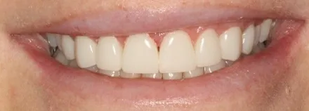 After: upper front teeth with composite veneers